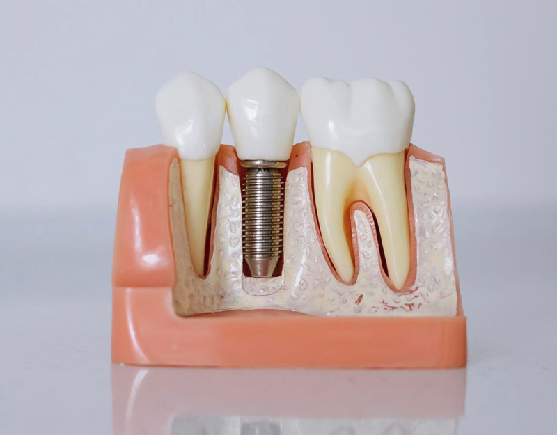 Implant img